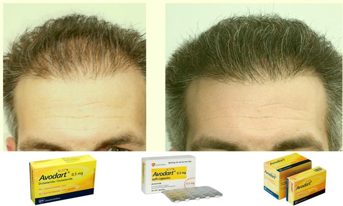 how to get avodart for hair loss